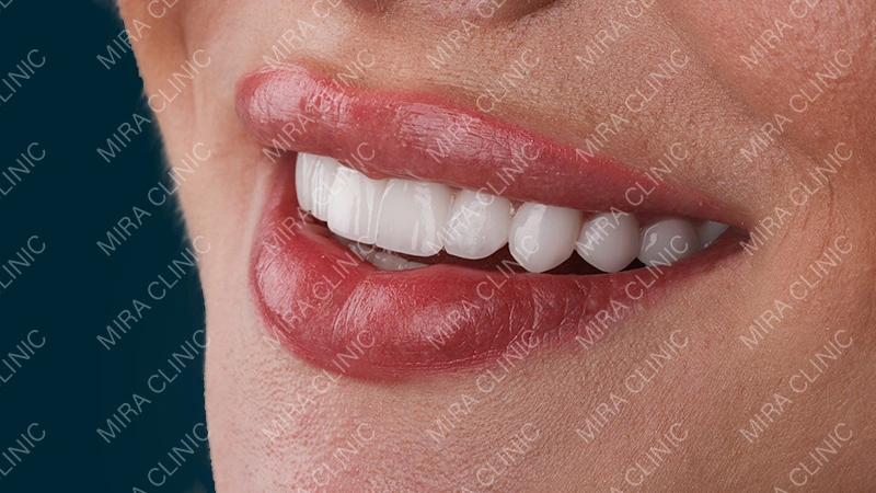 Hollywood smile reveal before after